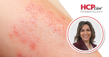 Discussing New Data on Treating HS, Psoriasis at EADV 2025 Congress, With Mona Shahriari, MD