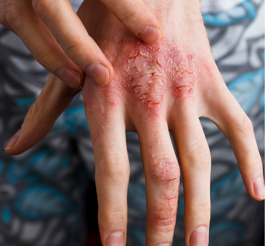 Switching to a Biosimilar from an Originator Deemed Safe and Effective in Psoriasis Treatment