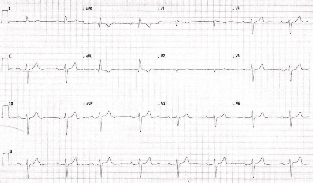 Sinus bradycardia