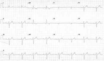 Sinus bradycardia