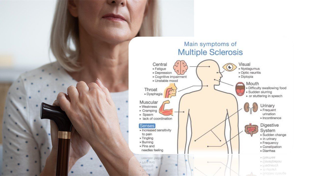 Case Report:  52-year-old woman with MS and generalized weakness