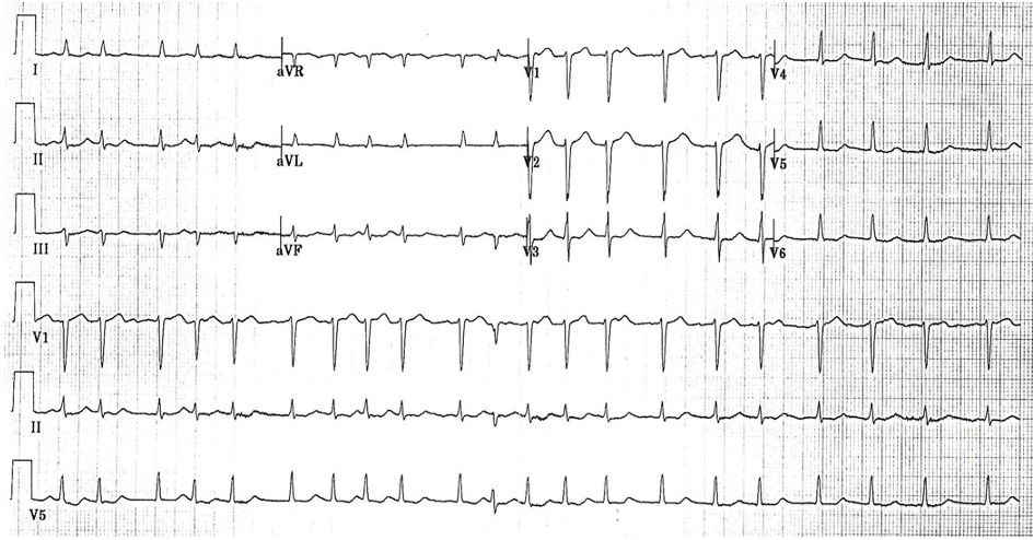 EKG printout
