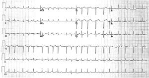 EKG printout