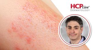 First in Class Rezpegaldesleukin: Favorable Safety, Durable Responses in Alopecia Areata, With David Rosmarin, MD