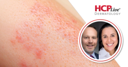 What Does New Phase 3 Amlitelimab Data Suggest for Atopic Dermatitis?