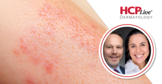 What Is Next for OX40 Ligand Inhibition in Atopic Dermatitis?