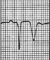 The Inverted T Wave Differential Diagnosis in the Adult Patient