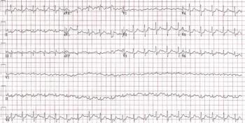 EKG of a patient experiencing alcohol withdrawal.
