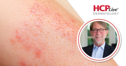 Spotlighting Updates in Psoriasis, PsA Management in 2026, With Philip Mease, MD