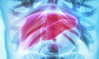 HCC in hepatitis C infected liver | Credit: Adobe Stock