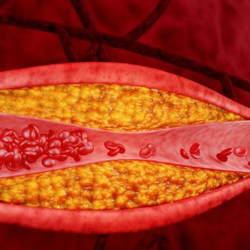 Evolocumab May Shift Plaque Profile Toward Lower Cardiovascular Risk | Image Credit: Adobe Stock