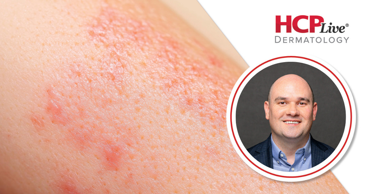 Q&A: How Is Precision Medicine Changing Atopic Dermatitis Care? With Jason Hawkes, MD