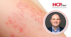 How Are New Biologics Changing Atopic Dermatitis Treatment?