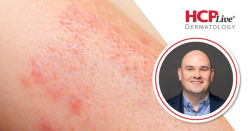 How Are New Biologics Changing Atopic Dermatitis Treatment?