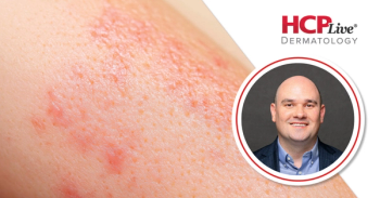 How Are New Biologics Changing Atopic Dermatitis Treatment?