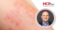 Q&A: How Is Precision Medicine Changing Atopic Dermatitis Care? With Jason Hawkes, MD