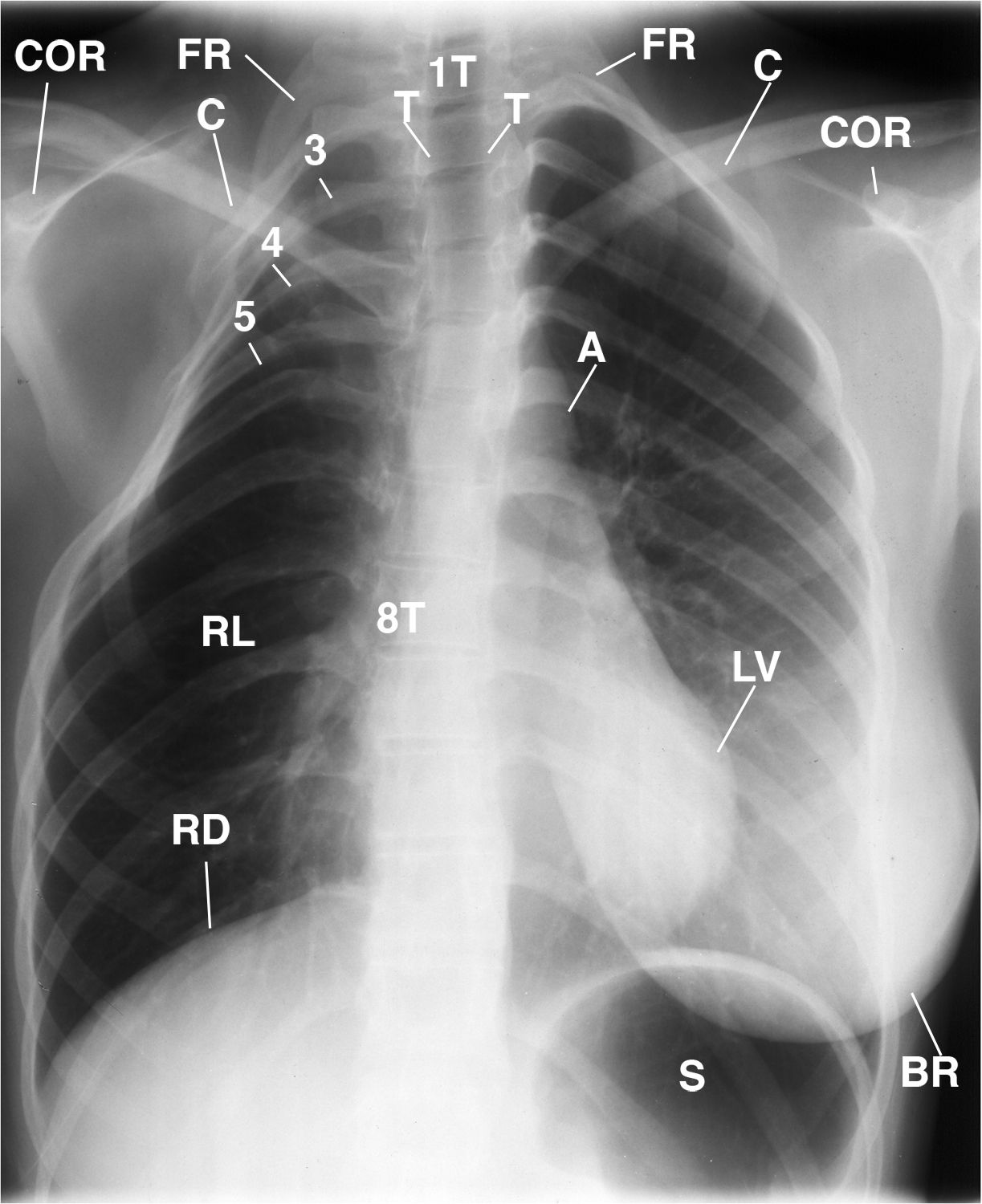 Specttcular Rib Why Does This Patient Have a Hyperlucent Right Lung and Rib Deformities?