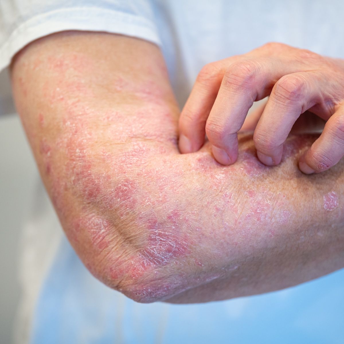 AC-201, an TYK2/JAK1 Inhibitor, Hits PASI-75 at Week 12 in Psoriasis Phase 2 Trial | Image Credit: Adobe Stock