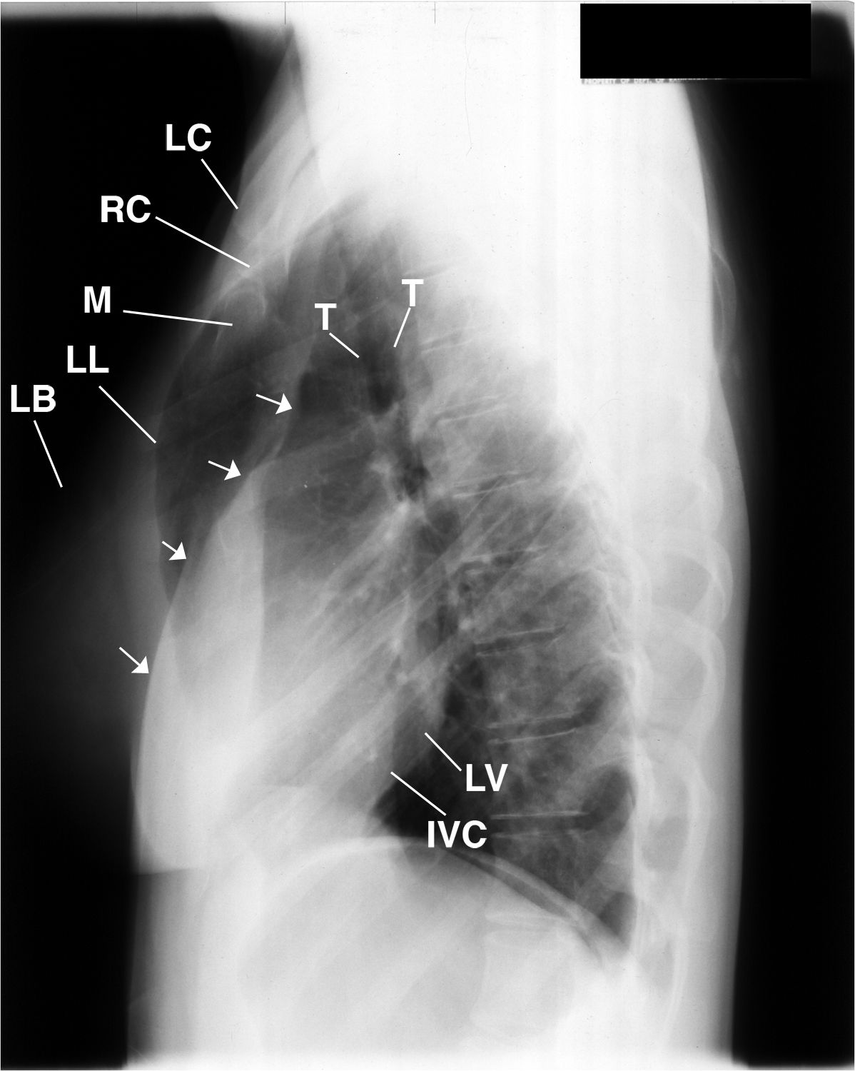 Why Does This Patient Have a Hyperlucent Right Lung and Rib Deformities?