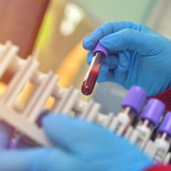 Knowledge of Severity, Susceptibility Shape Perceptions of Sickle Cell Trait Testing