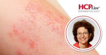 Significance of ADorable-1 Data on Lebrikizumab in Children with Atopic Dermatitis, With Amy Paller, MD