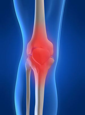 Diabetes and Osteoarthritis: A Vicious Cycle 