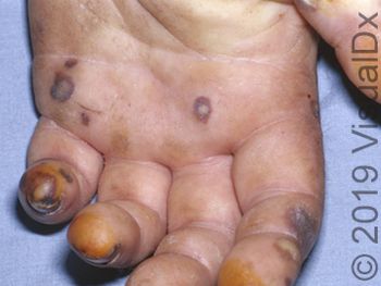 Image IQ: Mitral valve prolapse with multiple petechiae