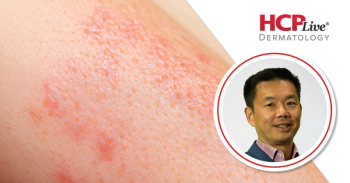 Discussing Phase 2b Findings on Temtokibart for Atopic Dermatitis, With Chih-ho Hong, MD, FRCPC
