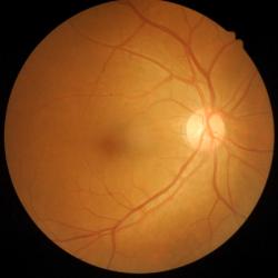OCT Features May Signal Risk of Retinal Atrophy, Study Suggests