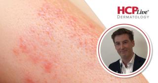 Upadacitinib Feasible for Palmoplantar Pustulosis: David Gleeson, BM BCH, PhD