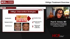EP. 2 Vitiligo Treatment Overview