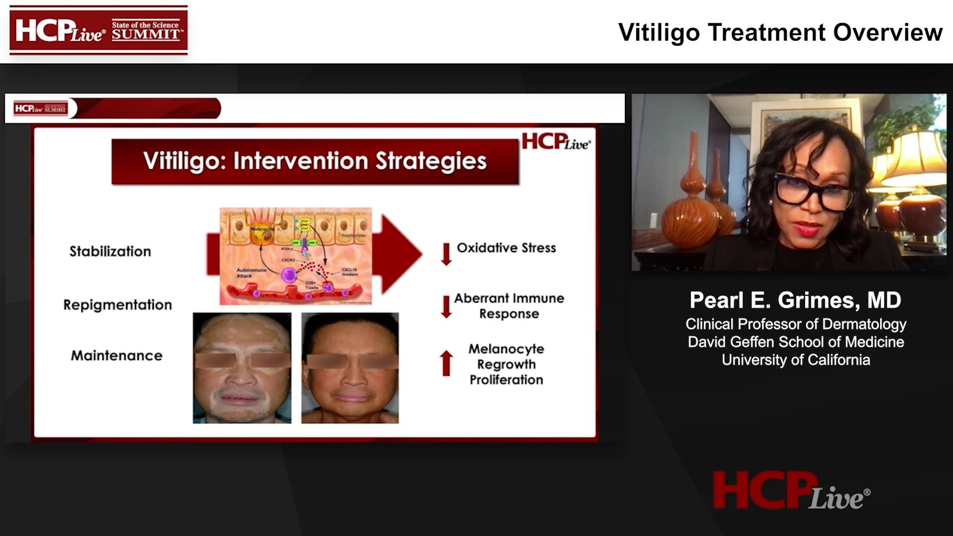 Vitiligo Treatment Overview Vitiligo Treatment Overview