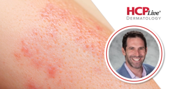 Progress with Emerging TYK2 Inhibitors for Psoriasis, With Benjamin Lockshin, MD