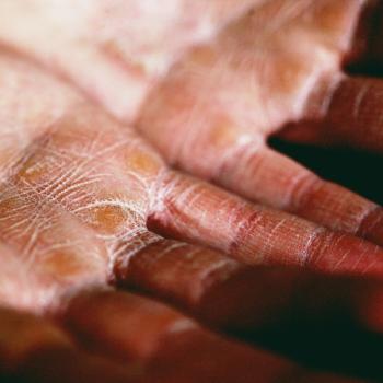 Atopic Dermatitis Closely Linked to Prurigo Nodularis in New Analysis | Image Credit: Alexander Grey/Unsplash