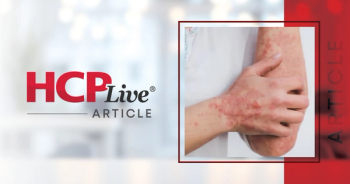 Tildrakizumab Effective in Real-World Settings for Psoriasis Over 76 Weeks