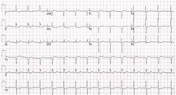 Computer Read: NSR at 85, ST & T wave abnormality, consider lateral ischemia, Prolonged QT. Credit: Brady Pregerson, MD