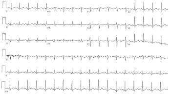 EKG readout