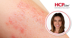 Navigating Corticosteroid Stewardship in Dermatology, With Kristina Derrick, MD
