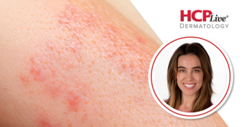 Navigating Corticosteroid Stewardship in Dermatology, With Kristina Derrick, MD