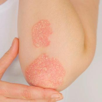Psoriasis May Be a Protective Factor for Certain Forms of Cancer, Research Suggests | Image Credit: Adobe Stock