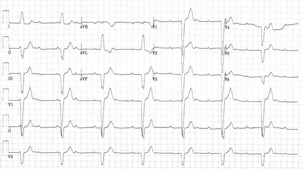 ECG printout for case report