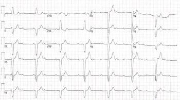ECG printout for case report