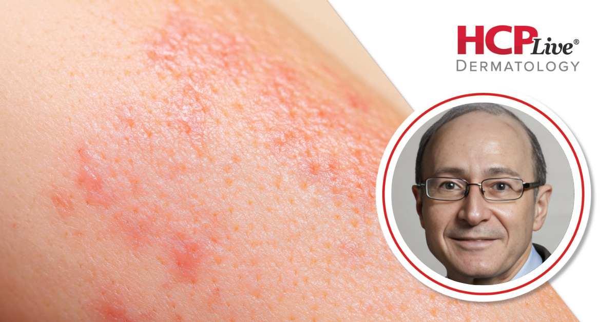 Remibrutinib Shows Rapid Symptom Relief in CSU, With Mark Lebwohl, MD