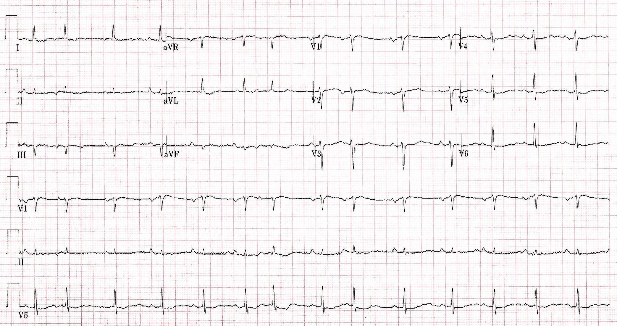 EKG readout