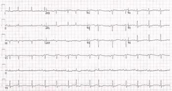 EKG readout