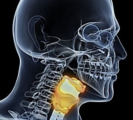 Hypothyroid, hypothyroidism, atrial fibrillation, free thyroxine