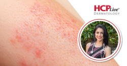 How to Differentiate Other Forms of Arthritis and Psoriatic Arthritis, With Shikha Singla, MD