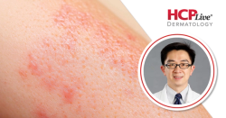 RADIANT-AD: Rademikibart Effective Over 52 Weeks in Atopic Dermatitis, With Cheng Zhou, MD