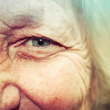 Baseline PED Correlates with BCVA Change in Treated nAMD Eyes