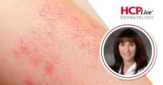 Treatment Selection, Adherence, and Misconceptions in Pediatric Atopic Dermatitis